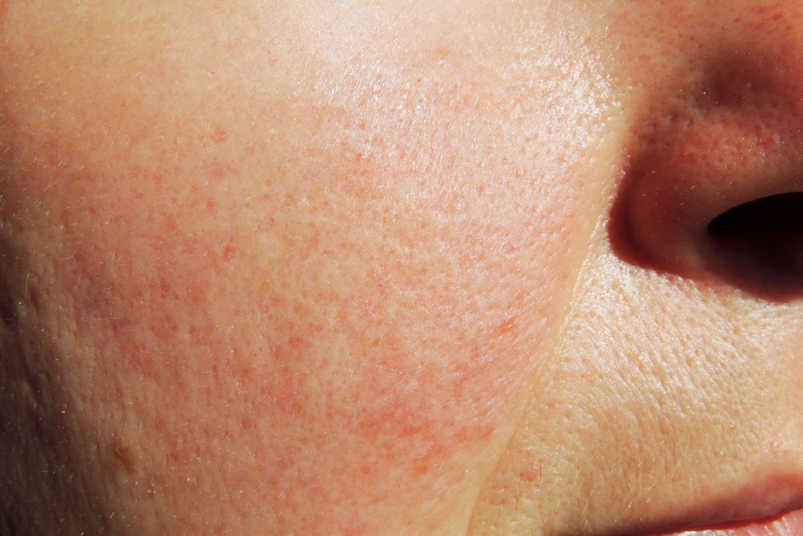 rosacea